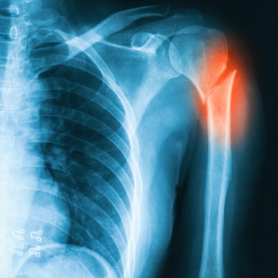 X-ray image of shoulder AP view